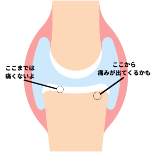 膝　膝の痛み　軟骨　変形性膝関節症